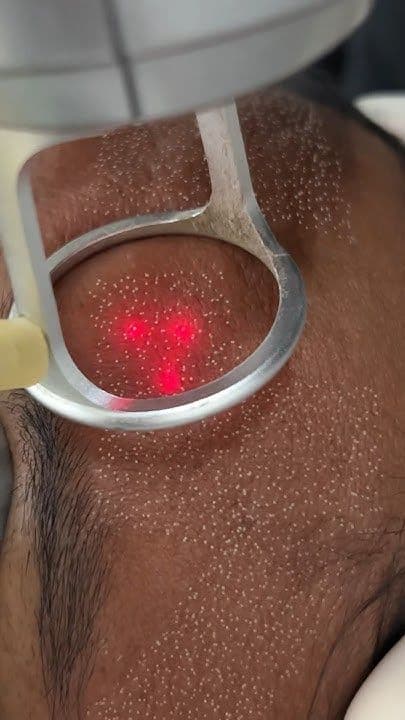 CO2 Laser for Scars