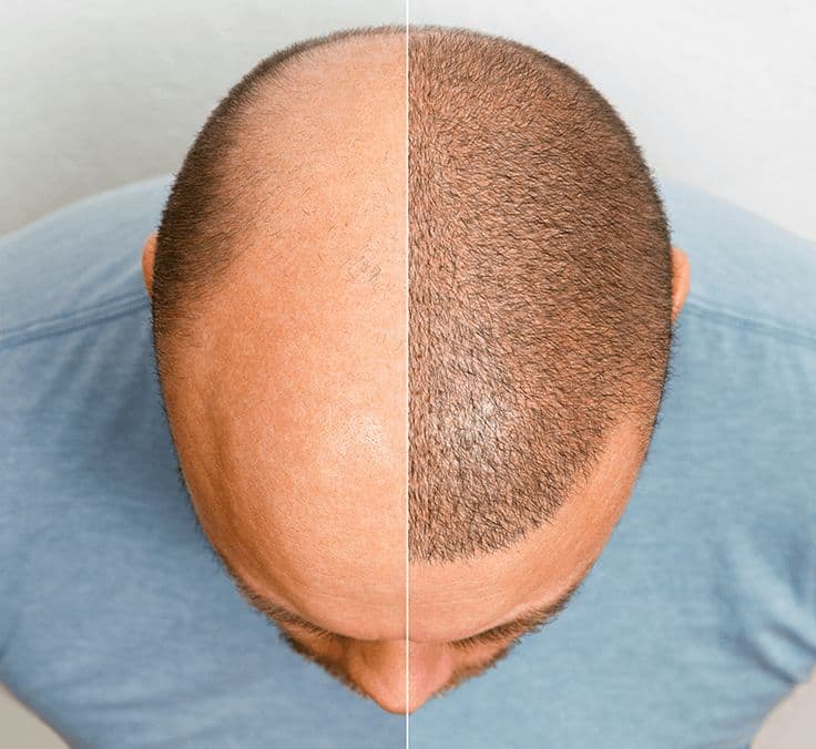 Hair Transplant