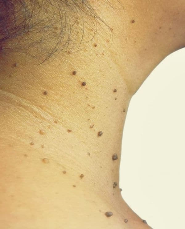 Skin Tags Removal
